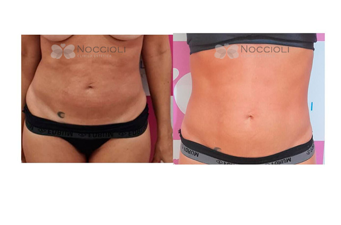 Lipo sem Corte