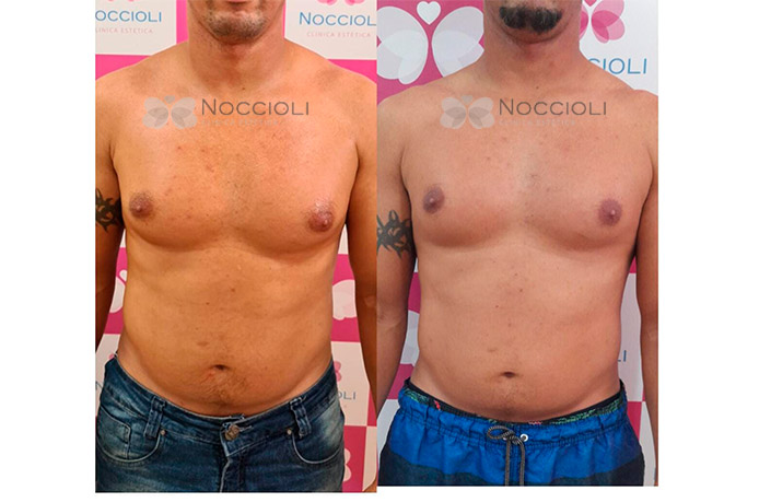 Criolipólise + Lipo sem Corte