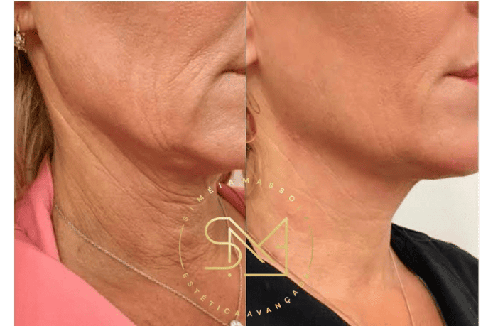 Antes e depois de um tratamento bioestimulador colágeno em um rosto feminino - Clínica Estética Noccioli Ribeirão Preto