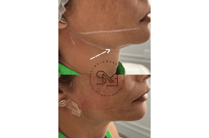 Antes e depois de um tratamento para contorno da mandíbula em um rosto feminino - Clínica Estética Noccioli Ribeirão Preto
