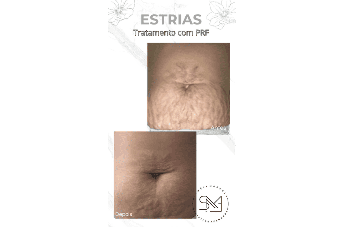 Antes e depois estrias no abdômen feminino I - Clínica Estética Noccioli Ribeirão Preto