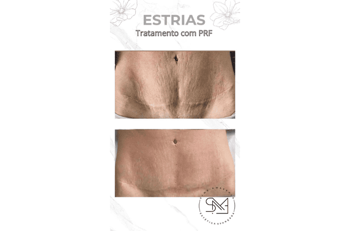 Antes e depois estrias no abdômen feminino II - Clínica Estética Noccioli Ribeirão Preto