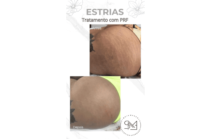 Antes e depois estrias nos glúteos feminino - Clínica Estética Noccioli Ribeirão Preto
