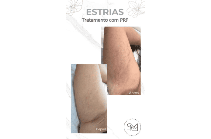 Antes e depois estrias no braço feminino - Clínica Estética Noccioli Ribeirão Preto