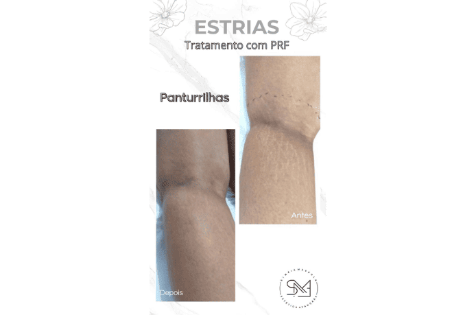 Antes e depois estrias na panturrilha feminina - Clínica Estética Noccioli Ribeirão Preto