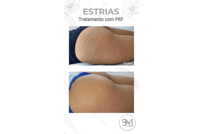 Antes e depois estrias nos glúteos feminino I - Clínica Estética Noccioli Ribeirão Preto