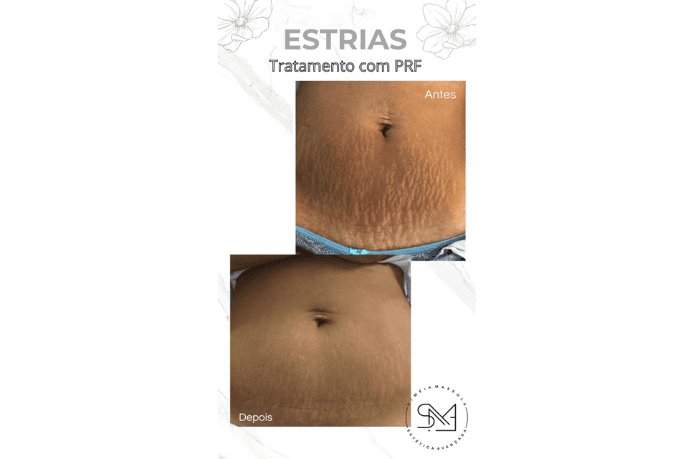 Antes e depois estrias no abdômen feminino - Clínica Estética Noccioli Ribeirão Preto