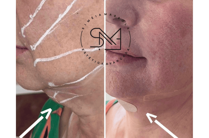 Antes e depois de procedimento de fios de sustentação de pescoço - papada - Clínica Estética Noccioli Ribeirão Preto