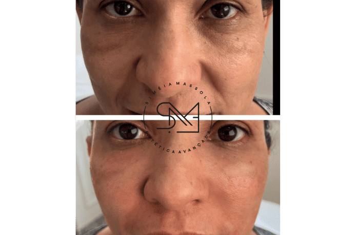 Antes e depois de tratamento para olheiras e bigode chinês em rosto feminino I - Clínica Estética Noccioli Ribeirão Preto