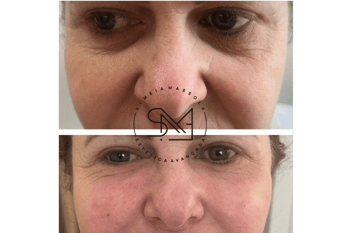 Antes e depois de tratamento para olheiras e bigode chinês em rosto feminino - Clínica Estética Noccioli Ribeirão Preto