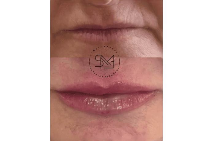 Antes e depois de um preenchimento labial em uma boca feminina I - Clínica Estética Noccioli Ribeirão Preto