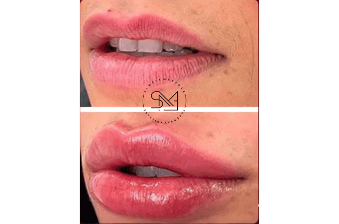 Antes e depois de um preenchimento labial em uma boca feminina - Clínica Estética Noccioli Ribeirão Preto