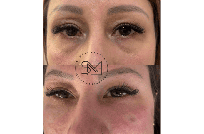 Antes e depois de tratamento para olheiras em rosto feminino - Clínica Estética Noccioli Ribeirão Preto